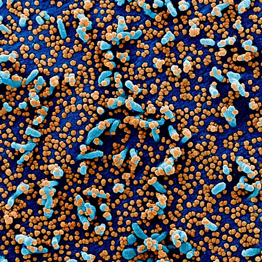 Una célula humana rodeada por SARS-CoV-2. Imagen coloreada.