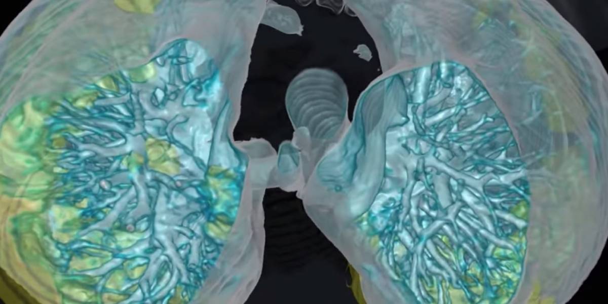 Coronavirus: video en 3D muestra cómo el COVID-19 afecta los pulmones