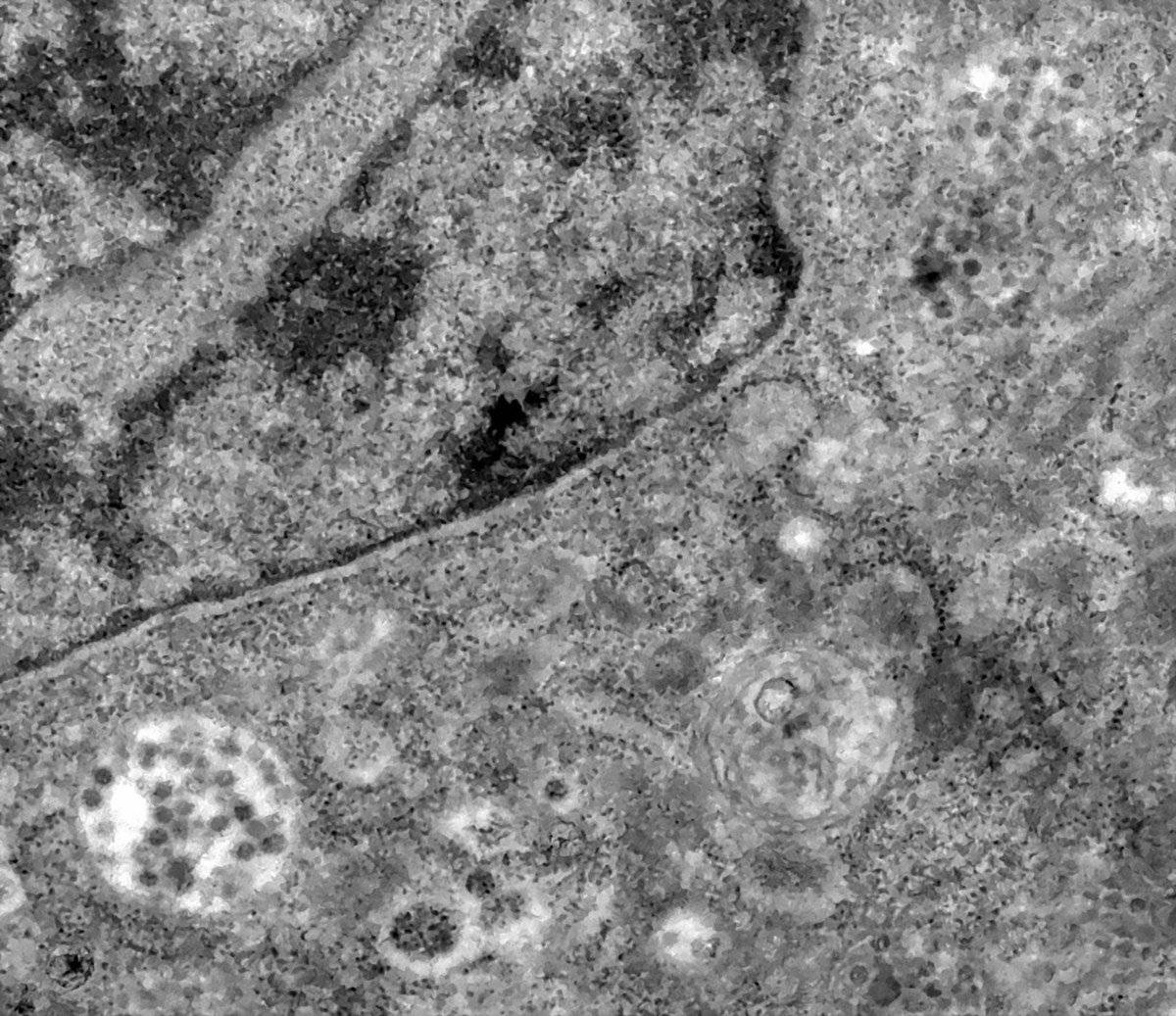 Coronavirus: científicos investigan relación entre células y casos graves de COVID-19 Coronavirus: científicos investigan relación entre células y casos graves de COVID-19