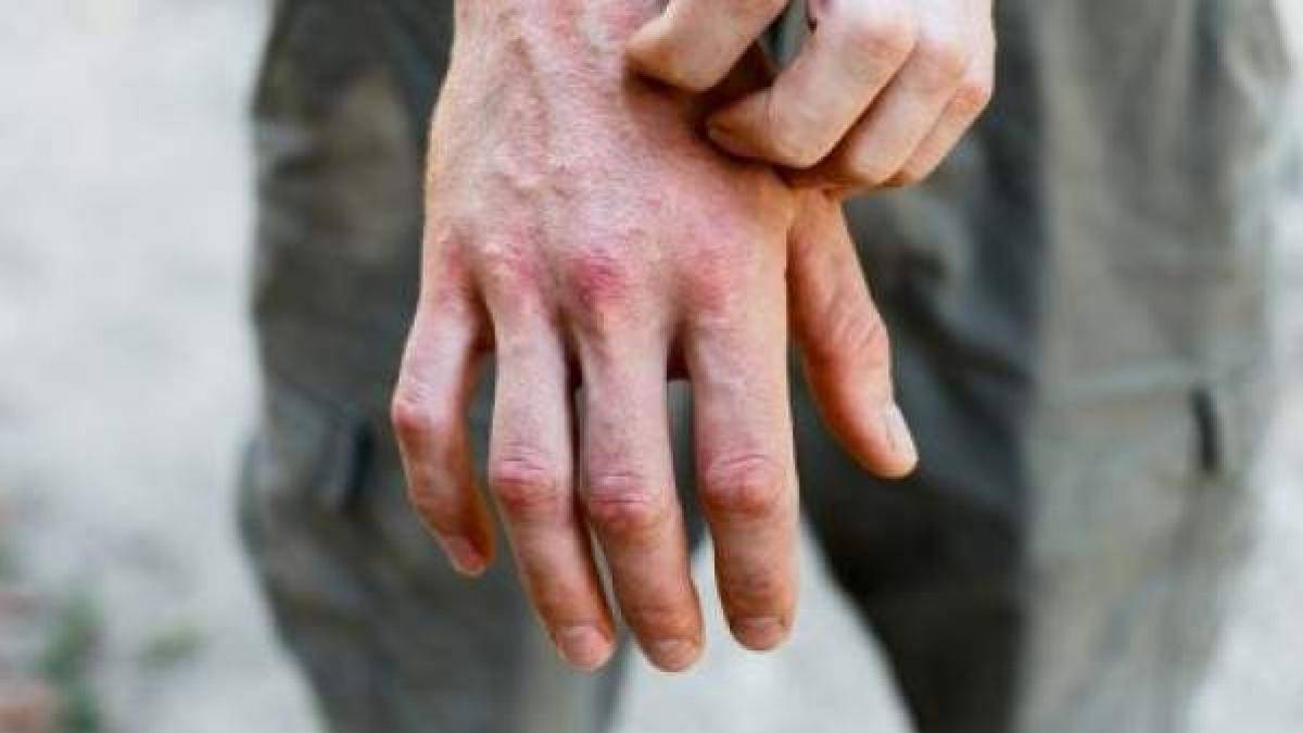 Coronavirus: así podrás diferenciar si una lesión de piel está relacionada con el COVID-19