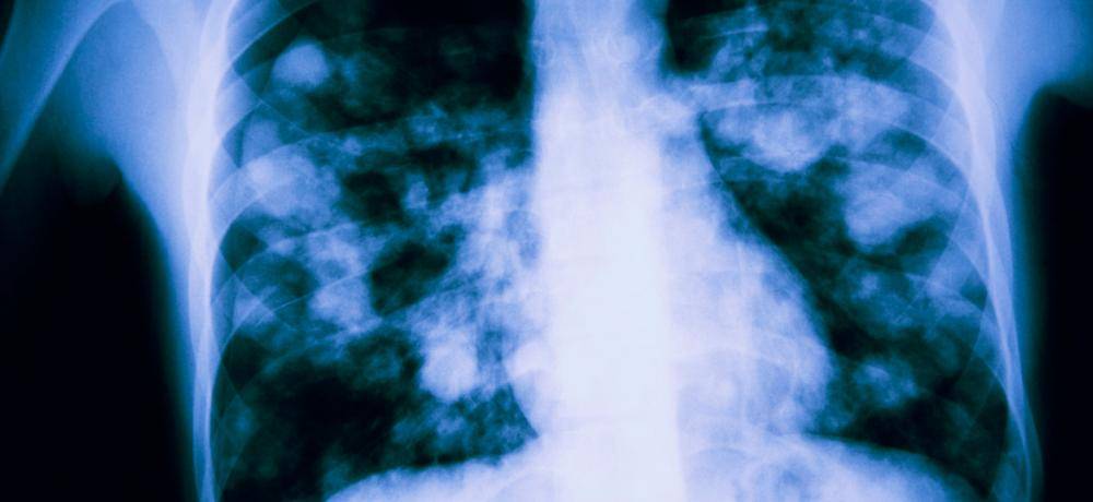 Pulmones con neumonía