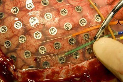 Macroelectrodos Cerebro Macroelectrodos Cerebro