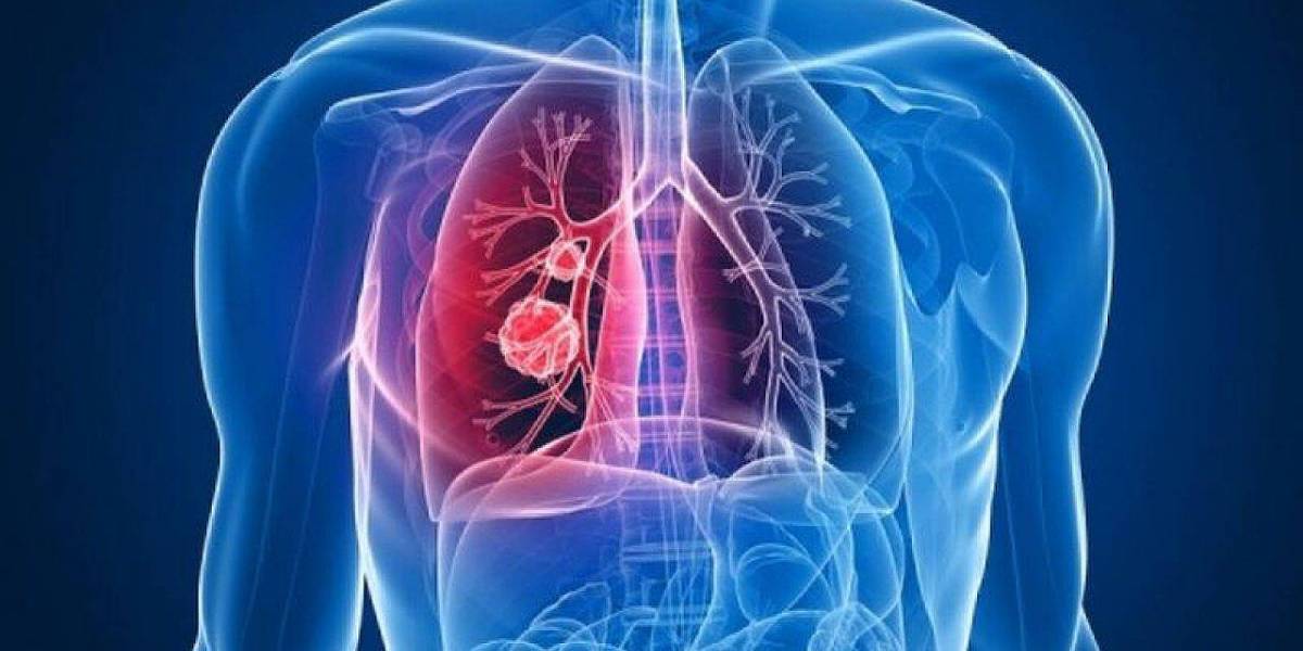 Coronavirus: pacientes asintomáticos desarrollan también daño pulmonar