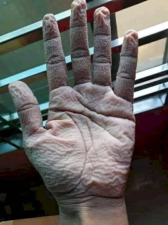 Así queda la mano de un médico al quitarse los guantes protectores tras 10 horas de trabajo