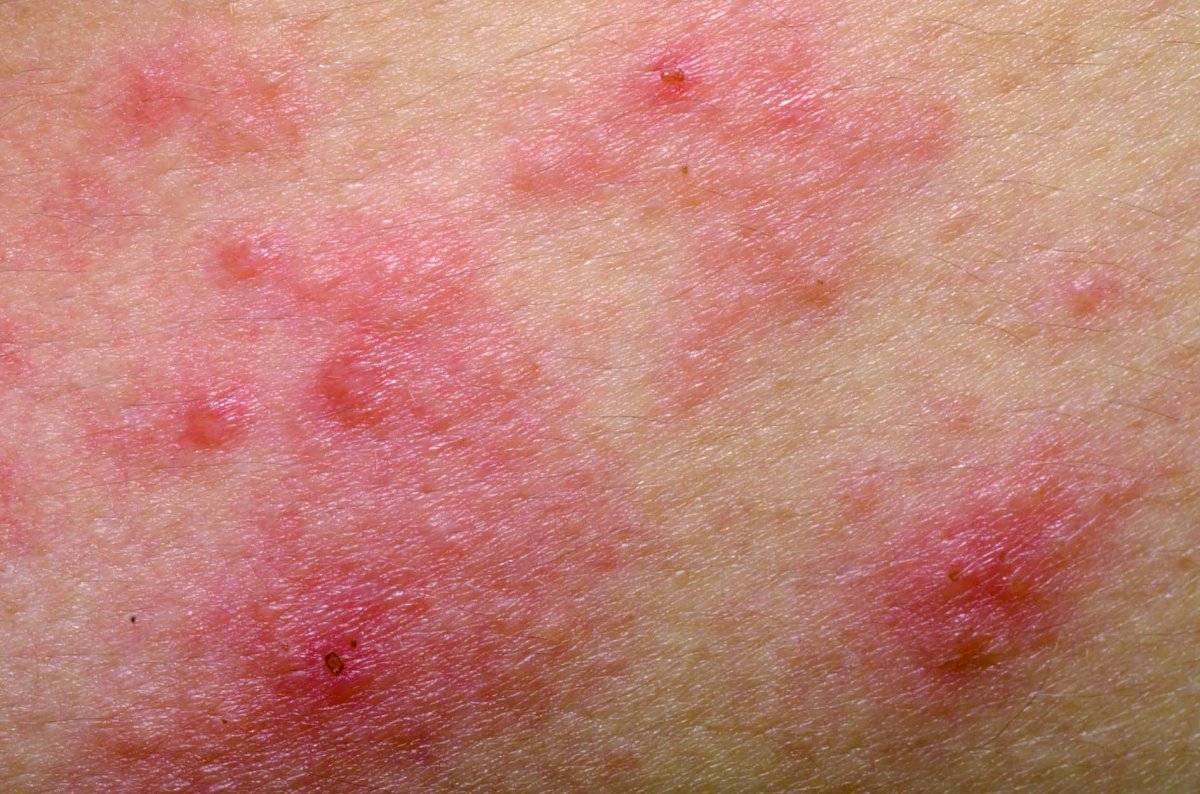 ¡Ojo con las erupciones en la piel! Serían otro síntoma clave del COVID-19