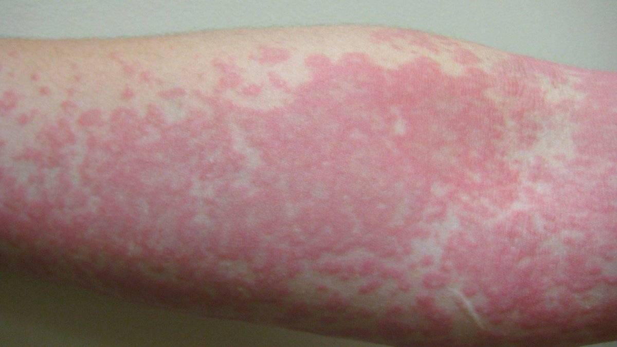 ¡Ojo con las erupciones en la piel! Serían otro síntoma clave del COVID-19