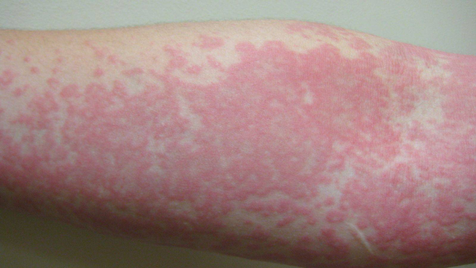 urticaria