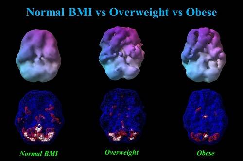 Cerebro y obesidad Cerebro y obesidad