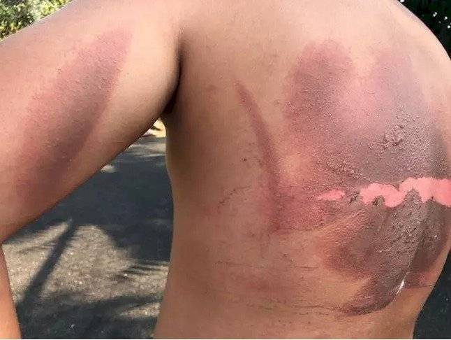 Joven sufrió quemaduras al explotarle el cargador del celular durante la noche