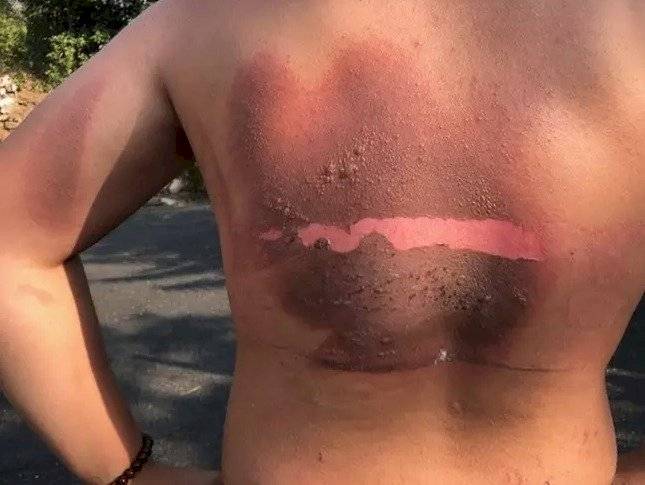 Joven sufrió quemaduras al explotarle el cargador del celular durante la noche