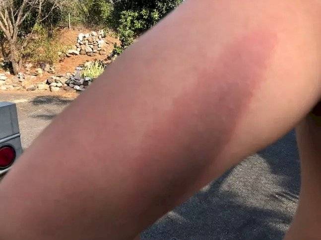 Joven sufrió quemaduras al explotarle el cargador del celular durante la noche