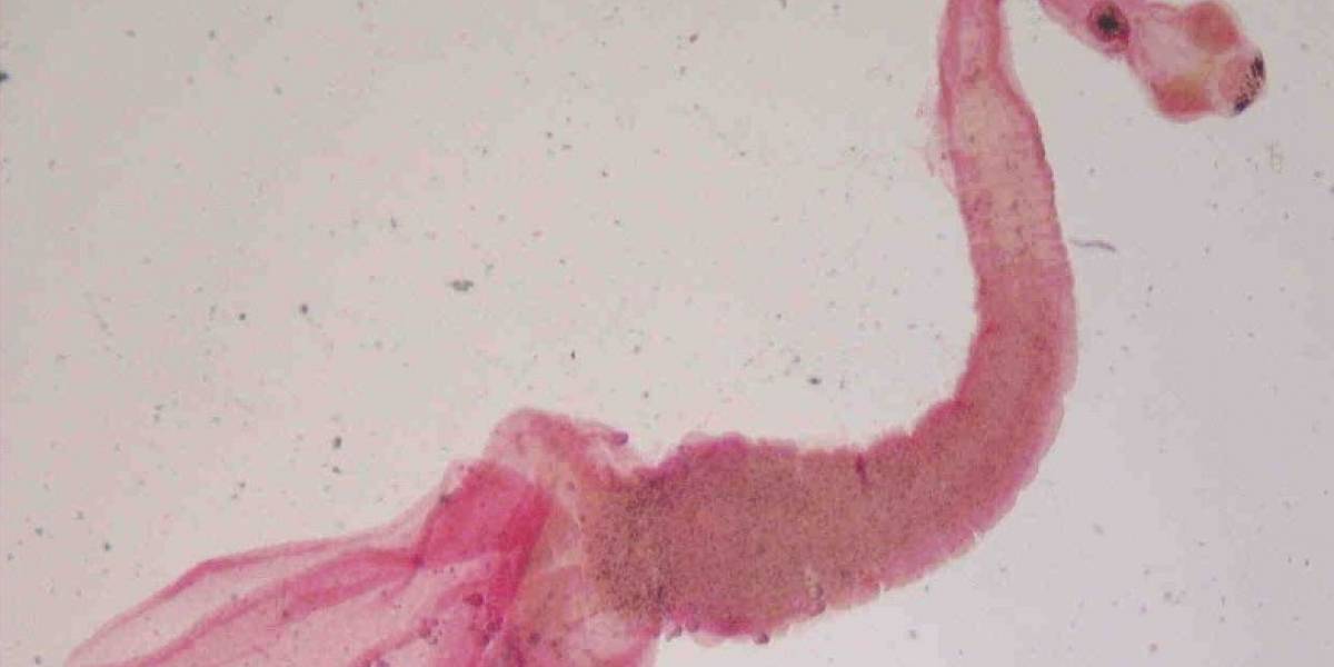 Mujer tenía un intenso dolor de cabeza: eran larvas en su cerebro