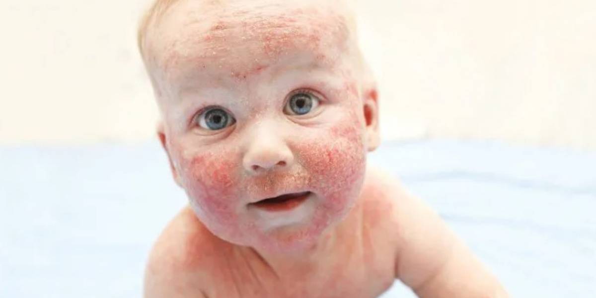 Escarlatina: ¿qué es esta fiebre que mató a millones de niños en el pasado?