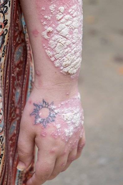 En Ecuador, más de 35 mil personas padecen de psoriasis