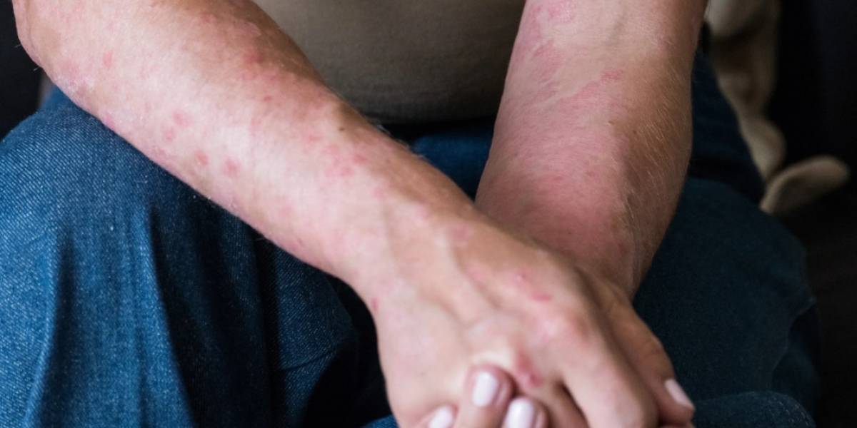 COVID-19: Descubren que el coronavirus también deja secuelas en la piel