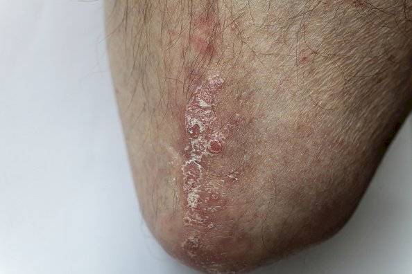 En Ecuador, más de 35 mil personas padecen de psoriasis