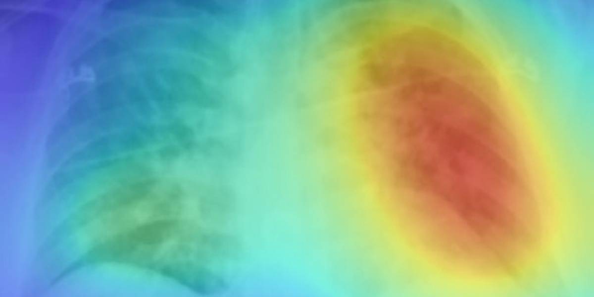 Así se ven pulmones con COVID-19 utilizando la Inteligencia Artificial