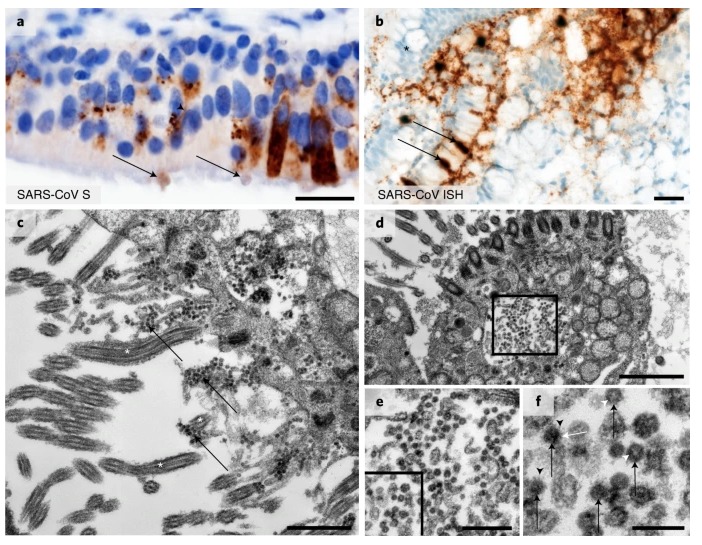  COVID -19 coronavirus cerebro 