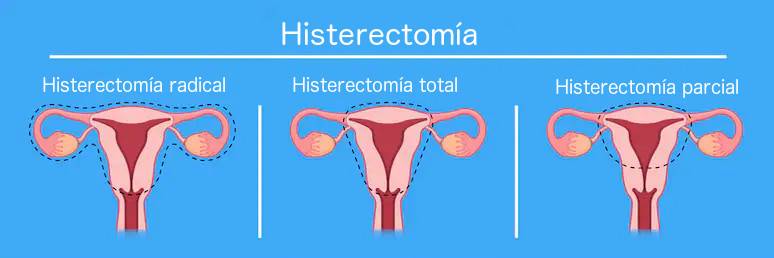 histerectomia