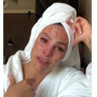Fabiola Campomanes se quema el rostro por obsesionarse con las manchas