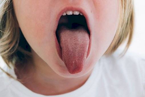 infectólogos europeos detectaron la “lengua covid”, el cual se une a otras señales como fiebre, dolor muscular, dificultad respiratoria y tos.