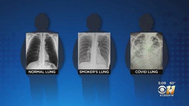 Pulmones de paciente con coronavirus