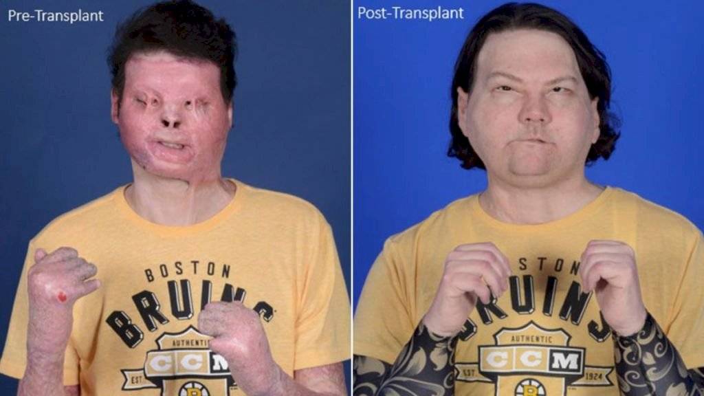 El resultado del primer trasplante de rostro y manos del mundo