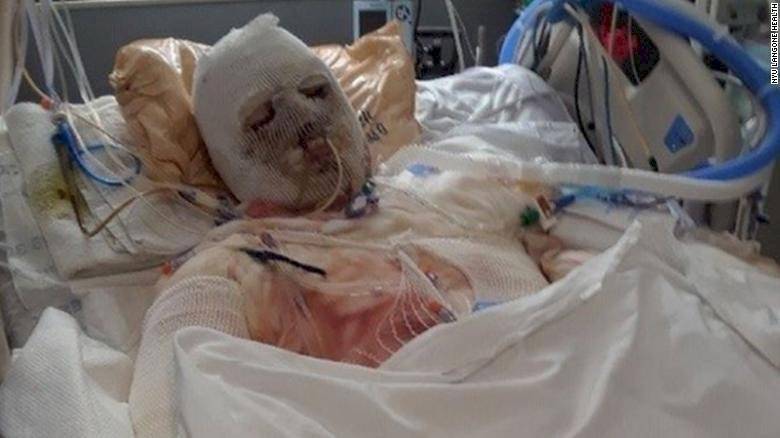 El resultado del primer trasplante de rostro y manos del mundo