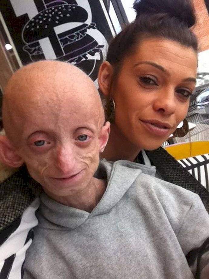 progeria-dde0f7216390bb6e8992b6f8d39ea51a.jpg